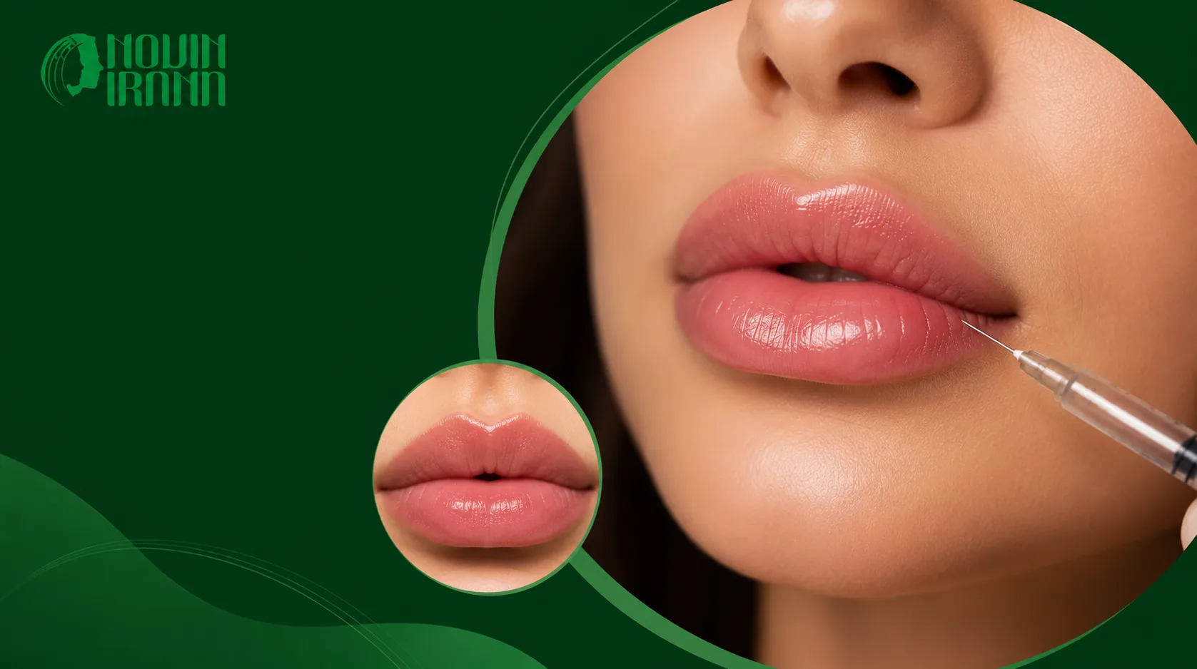 مزایای تزریق ژل لب مدل چاک دار مشهد